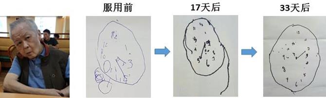 新加坡『脑复生』:改善老年痴呆的新希望