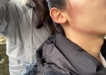 ic护肤攻略:用甲硝唑凝胶祛痘应对口罩脸过敏现象可行吗?