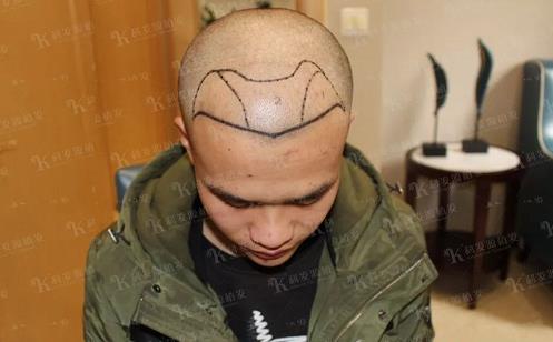 青岛大麦微针植发2500毛囊单位,术后8个月恢复头发浓密