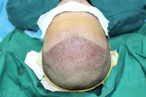 青岛大麦微针植发2500毛囊单位,术后8个月恢复头发浓密