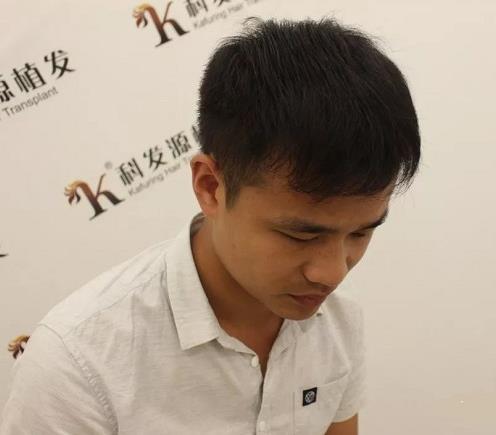 青岛大麦微针植发2500毛囊单位,术后8个月恢复头发浓密