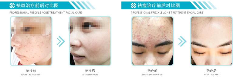白博士祛痘祛斑怎么样?