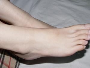 脚上长鸡眼怎么办？如何预防脚上长鸡眼