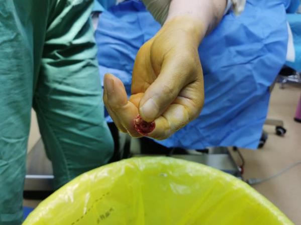 济南圣玛丽亚医院成功完成断指再植手术——手指奇迹般“复活”!