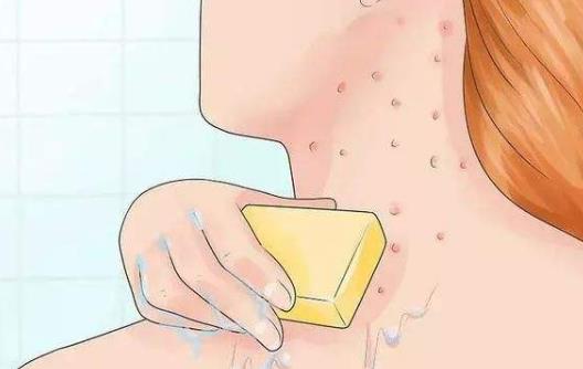 毛囊炎有哪些危害?患毛囊炎有哪些注意事项及护理?