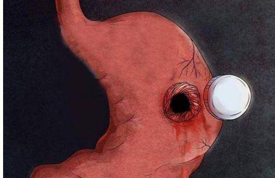 胃穿孔有哪些治疗方式?胃穿孔有哪些检查方式及怎么预防?