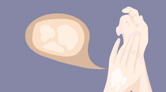 患白癜风的病因有哪些?怎么预防白癜风?