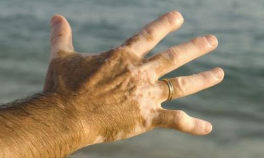 患白癜风有哪些症状?患白癜风的危害有哪些?