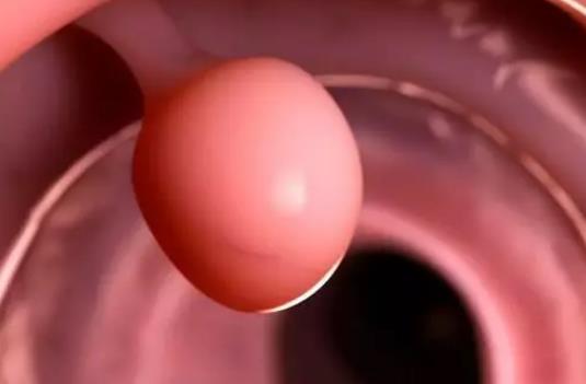 直肠多发息肉会癌变吗?为什么会患直肠息肉?