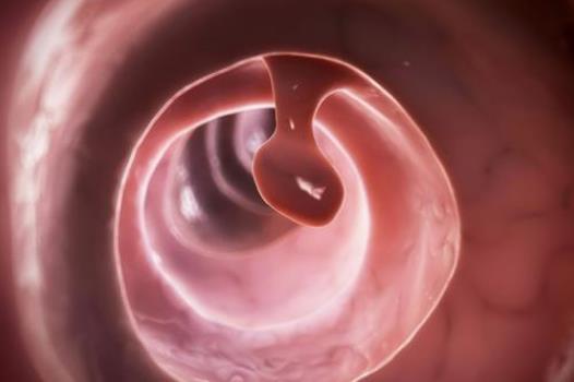 直肠多发息肉会癌变吗?为什么会患直肠息肉?