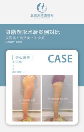 虑做大小腿吸脂手术可以先让医生面诊在做手术——北京吸脂医生刘靖涛