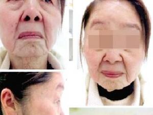 少妇分娩后变老太 获得性面部皮肤衰老症怪病