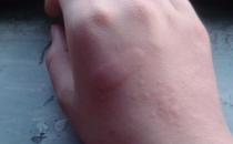 风疹的传播途径是什么？ 如何更好的进行防治