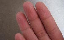 手癣——传染性很强的病