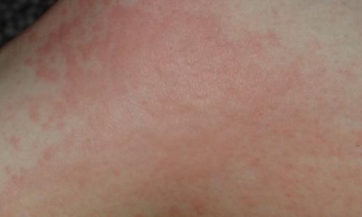 过敏患者越来越多 造成过敏的因素有哪些