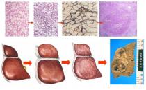 如何预防脂肪肝？注意哪些习惯？