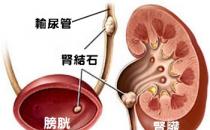 如何预防泌尿系结石 ?