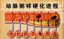 什么是“动粥”？哪些是“动粥疾病”高危人群？