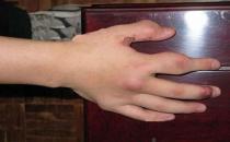 秋冬警惕风湿性关节病 如何预防？