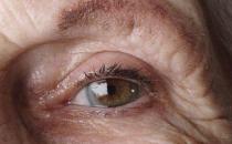 老人患上白内障的症状是什么