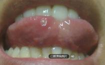 治疗口腔溃疡的偏方及饮食禁忌