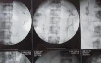 男子体内长四个肾，可以买肾6了
