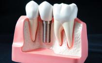 老人戴假牙的8个注意事项