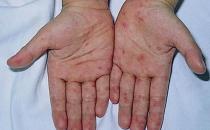 学生手掌出现红点别大意