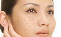 黄褐斑怎样去除 3招脸上亮白无瑕