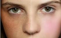 别让晒斑爬上脸 5个祛斑技能