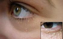 粒粒皆辛苦？找准原因轻松治脂肪粒！