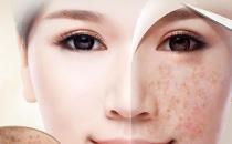祛斑有新招：用什么洗脸能祛斑