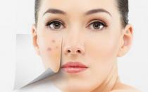 最有效的去痘食物疗法