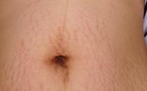 产后如何去除腹部妊娠纹