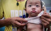 儿童性早熟发生率逐年增多