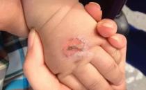 孩子常见的意外损伤类型有哪些？