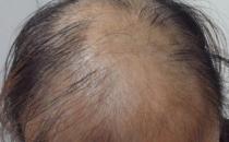 男性养生必知：男人性衰老7大迹象