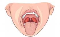 扁桃体发炎吃什么汤 食疗效果好