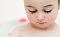 过敏性皮炎都有哪些症状