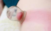 拔火罐帮你治疗冬季疾病