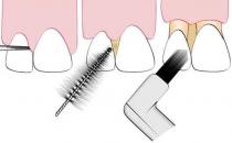 牙龈出血怎么回事？该如何预防牙龈出血