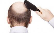 想要远离脱发 男人应做持久战