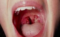 扁桃体结石需要安全护理 扁桃体结石形成原因及危害