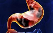 胃癌活动期的饮食禁忌 晚期胃癌患者的护理大全