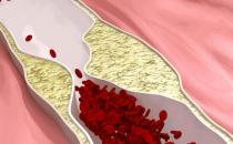 人到40岁血管易堵 颈动脉堵塞的原因揭秘