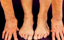 类风湿越吃越健康的食物 类风湿关节炎的饮食原则