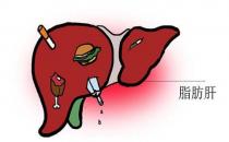 教你脂肪肝逆转回正常 做好日常预防防止演变成癌 