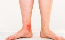 淤血体质调理食物有效祛瘀 保持心情舒畅作息规律