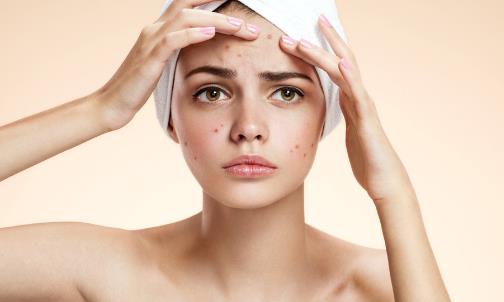 预防青春痘的4个方法