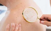 皮肤高度过敏也要学会保湿 皮肤高度过敏注意防晒